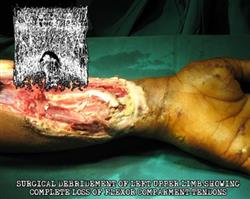 Download MxOxPxCxBxIxTxIxLxOxTxBxVx - Surgical Debridement Of Left Upper Limb Showing Complete Loss Of Flexor Comparment Tendons