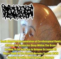 Download Hydrocephalus - Rapid Abnormal Accumulation Of Cerebrospinal Fluids Csf In The Ventricles Deep Within The Brain Leading To An Increase In Volume Occupied By These Fluids In The Central Nervous System Cns Causing Swelling And Permanent Damage Ep